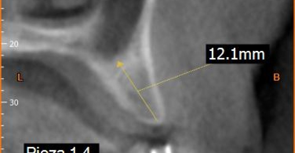 Implantes