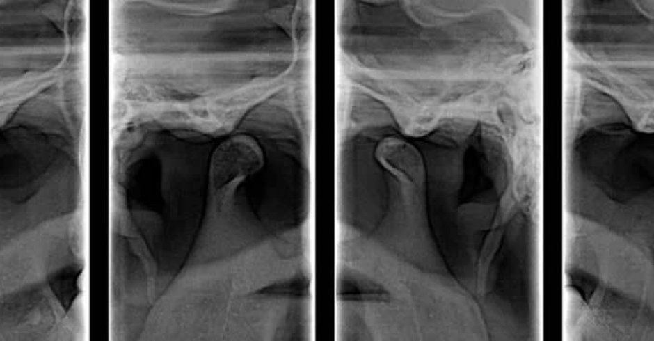 Técnica radiológica destinada a obtener una única imagen de las estructuras faciales que incluya las arcadas maxilar y mandibular, y sus estructuras de sostén. Son una parte importante del tratamiento dental (tanto para adultos como para niños), ya que pueden detectar daño en los dientes y estructuras adyacentes  que no son visibles durante un examen visual de rutina.