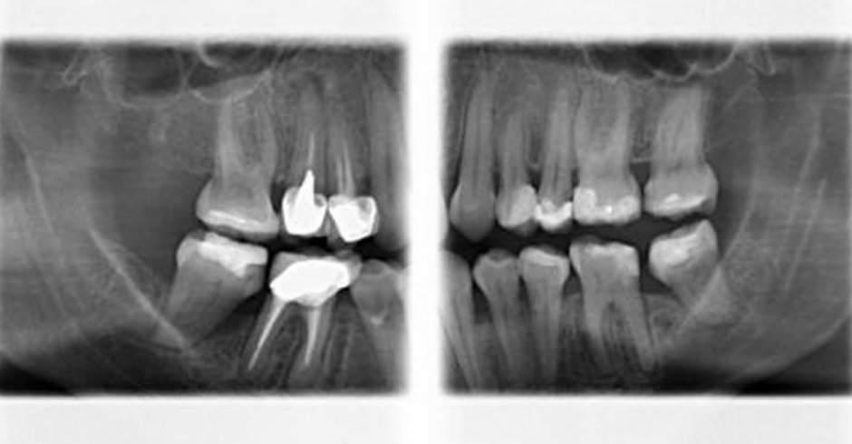 A.T.M. (Boca abierta/Boca cerrada)