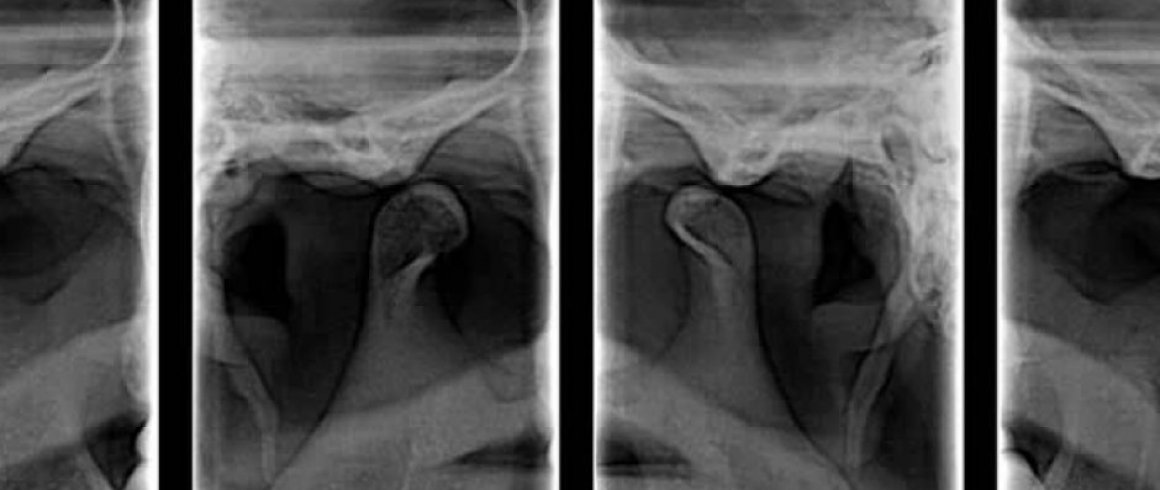 Técnica radiológica destinada a obtener una única imagen de las estructuras faciales que incluya las arcadas maxilar y mandibular, y sus estructuras de sostén. Son una parte importante del tratamiento dental (tanto para adultos como para niños), ya que pueden detectar daño en los dientes y estructuras adyacentes  que no son visibles durante un examen visual de rutina.