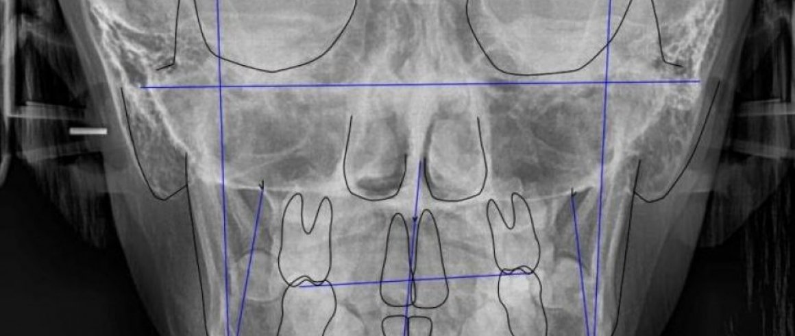 Análisis Cefalométrico Frontal