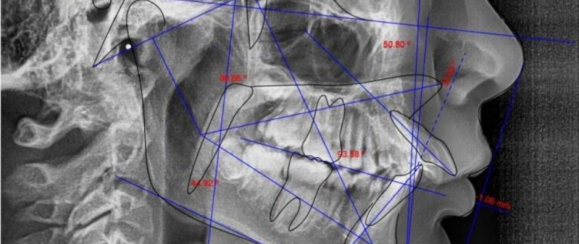 Lateral (Cefalometrica)