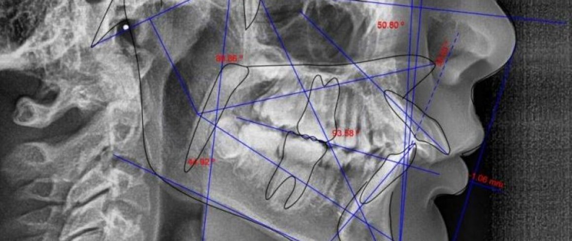 Análisis Cefalométrico Lateral